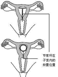 最新避孕措施，科学选择，健康生活之道